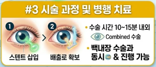 녹내장 수술