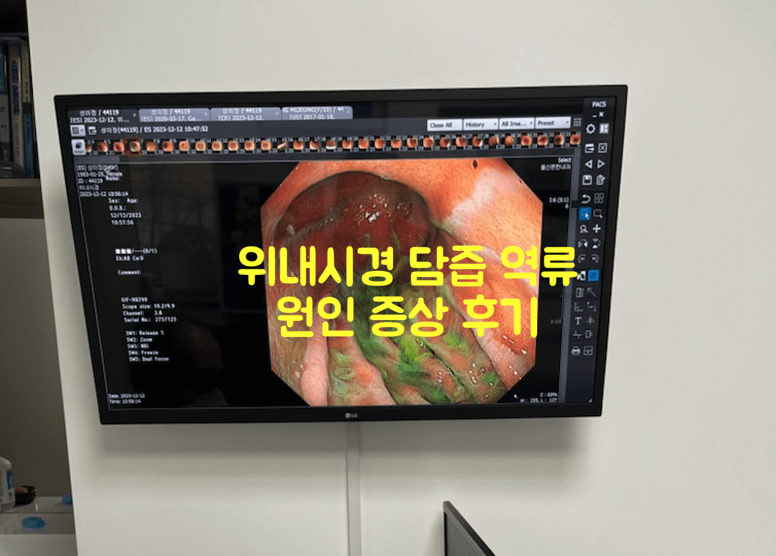 담즙 역류