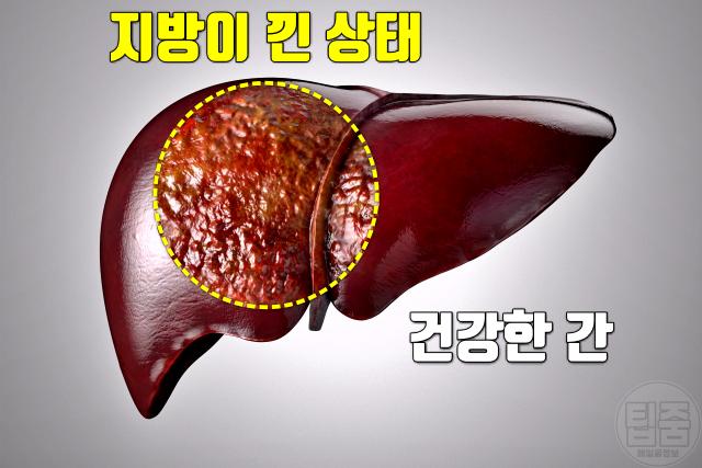 지방간 증상 비알코올성지방간 콜레스테롤