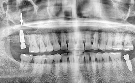 임플란트_비교사진