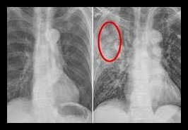 폐렴 예방접종 가격 시기
