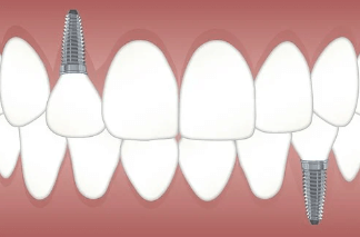 노인 임플란트 틀니 국가지원금