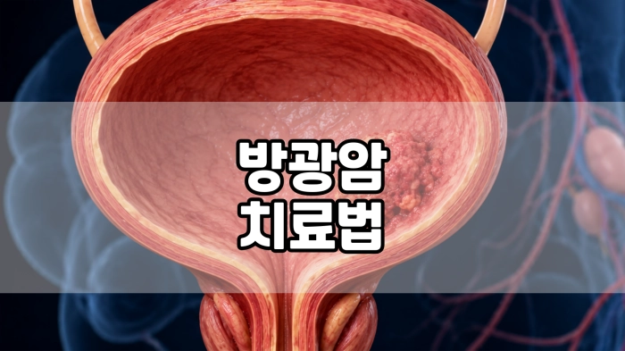방광암 치료법