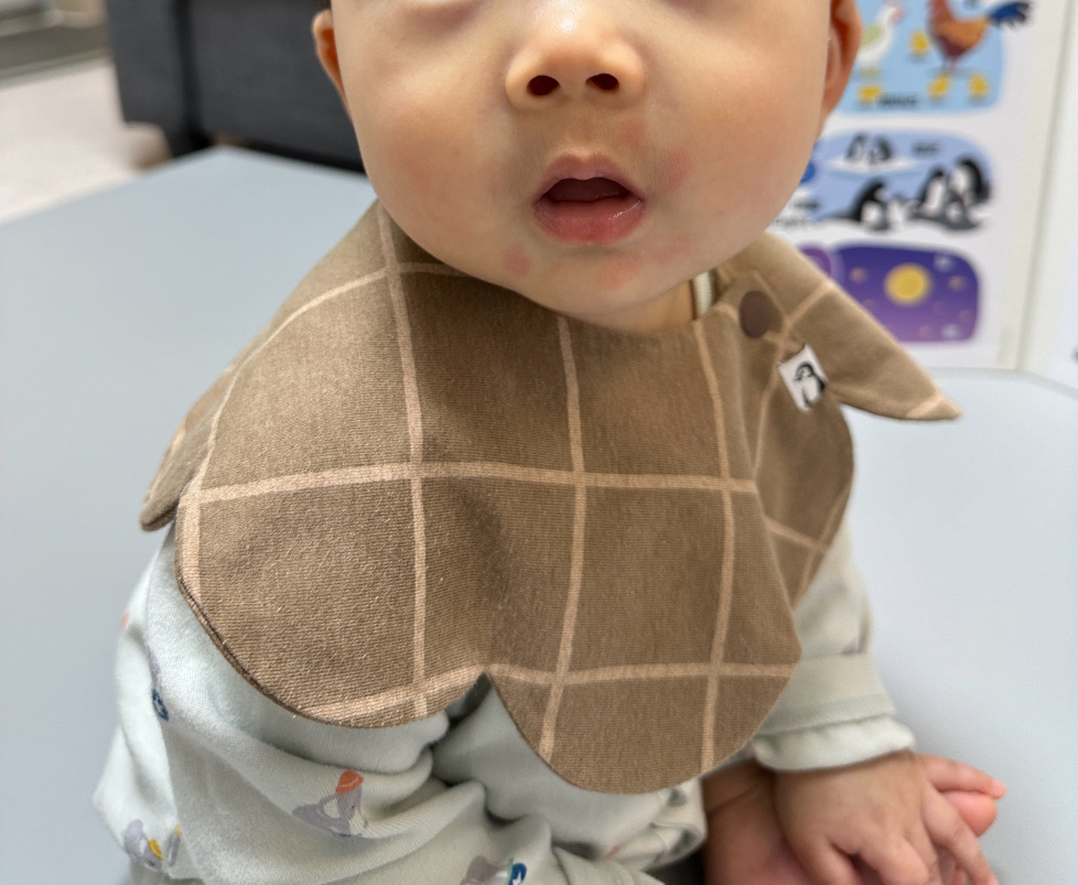 아기 입 주변에 수포가 난 사진