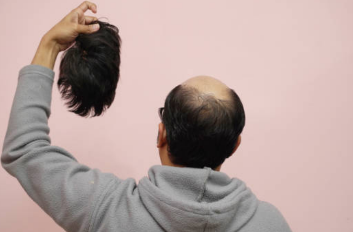 가발을 벗는 꿈