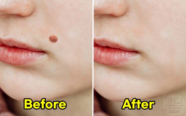 점 빼고 관리 색소침착 패인 흉터 점빼기 회복기간