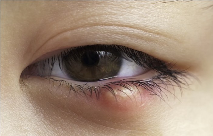 눈-다래끼-빨리-낫는법