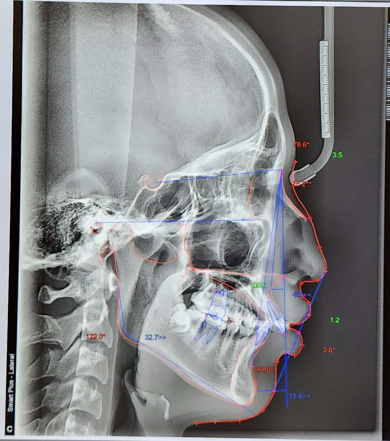 부정교합 가위교합 과개교합 치아교정 후기21