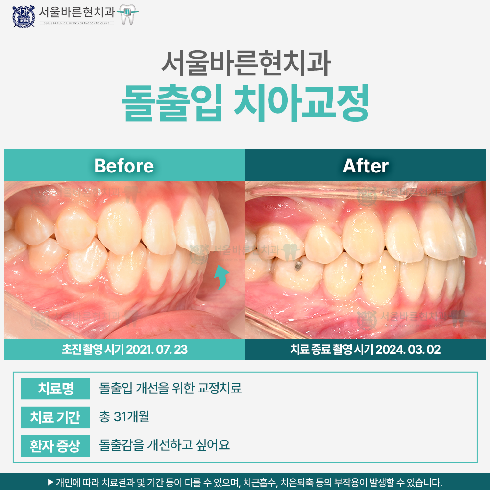 해운대치아교정