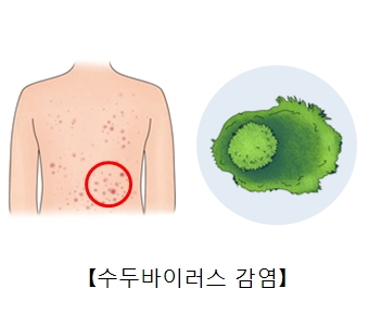 대상포진 수두바이러스