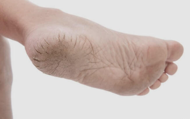 당뇨발-초기증상