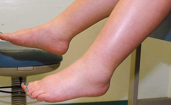 다리가 붓는 이유