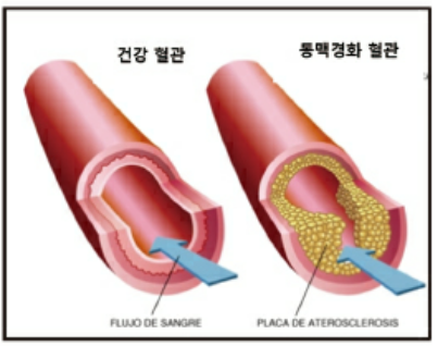 동맥경화증