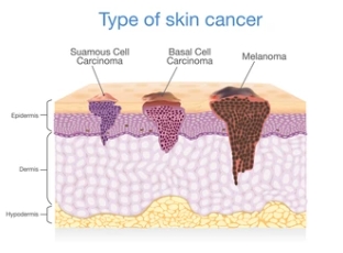 피부암의 발생기전과 예방음식 및 치료요법 안내