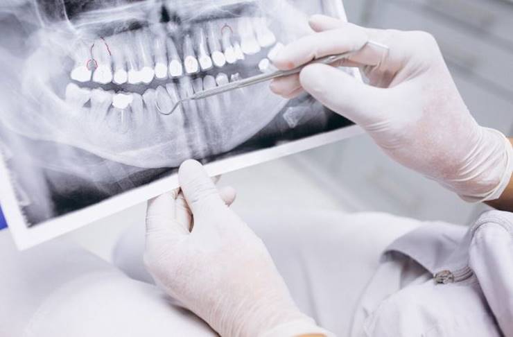 치과 엑스레이 사진