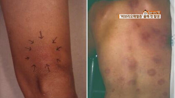 패혈증 증상 이미지
