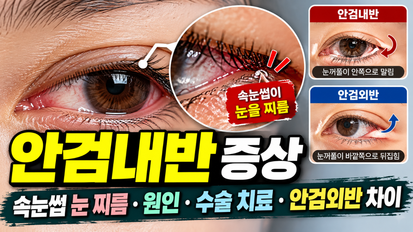 안검내반 증상｜속눈썹 눈 찌름&middot;원인&middot;수술 치료&middot;안검외반 차이