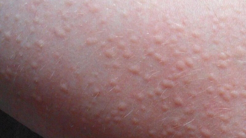 울퉁불퉁한-두드러기-모양의-피부
