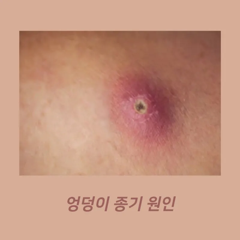 엉덩이 종기가 생기는 이유 왜 생기고 어떻게 관리할까요 완벽 가이드_8