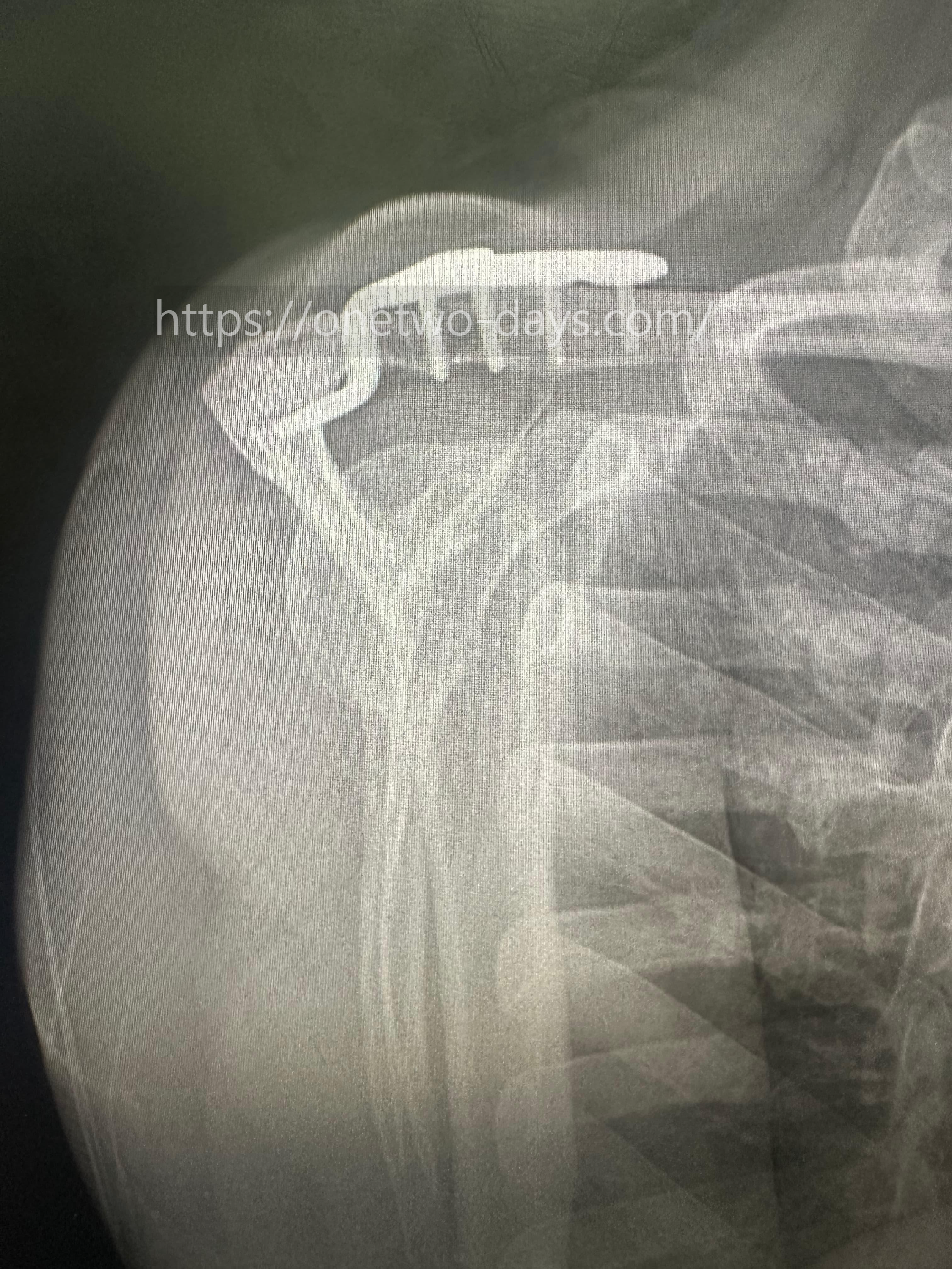 견쇄관절 탈구 후크플레이트 수술 정기검진 x-ray 사진 2