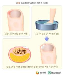 부산 내성발톱
