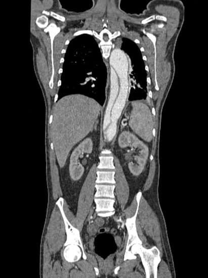 대동맥 박리(Aortic Dissection): 원인, 증상, 치료 및 예방법 총정리