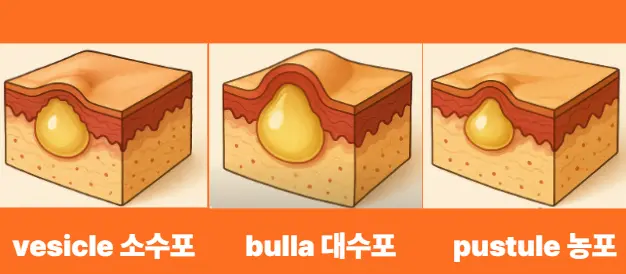 소수포 대수포 농포 피부병소