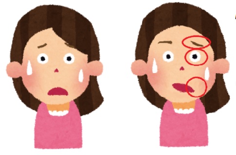 구안 와사(말초성 안면 신경 마비)는 안면 신경이라는 뇌에서 두개골 속을 통해 얼굴 표면에 나오는 뇌 신경에 장애가 생긴 것을 말합니다.