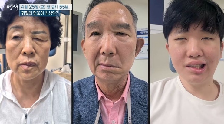 침샘암으로인한안면마비-명의헬스케어
