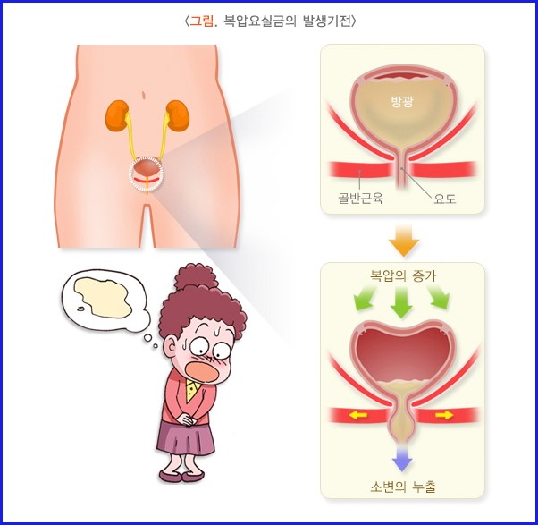복압요실금 발생 기전