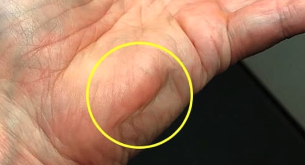 칼슘부족 초기증상