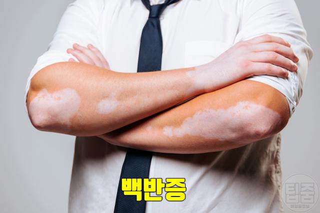 피부에 흰점 생기는 이유 백반증 얼굴흰점 원인