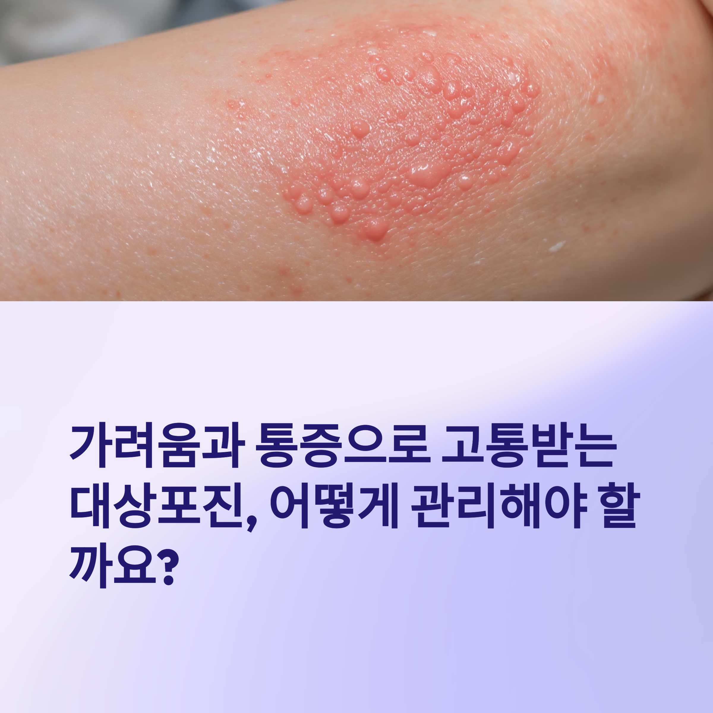 대상포진 가려움, 냉찜질이 좋을까 연고가 좋을까? 확실한 관리법 정리