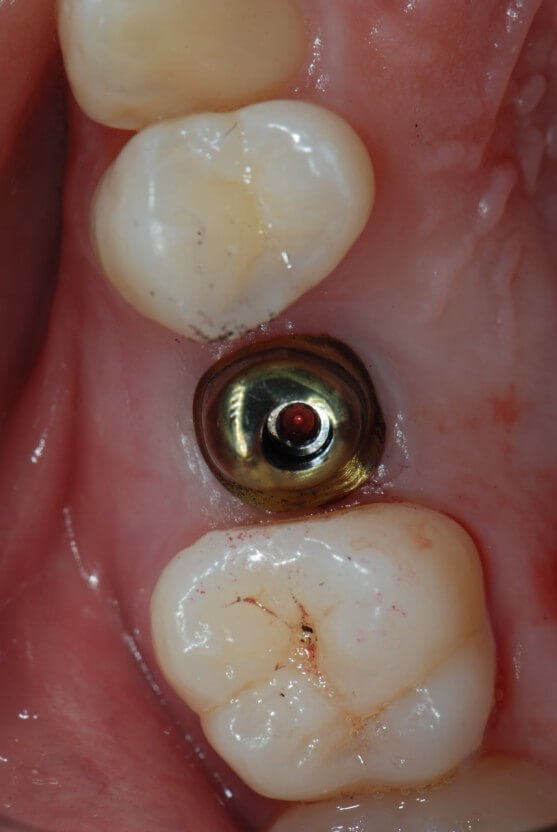 임플란트 보험 임플란트 가격 임플란트 비용 치아 보험 추천 치과 보험 추천 임플란트 치아 보험 치아 보험 적용 기과 보험 적용 치과 보험 임플란트 임플란트 치아
