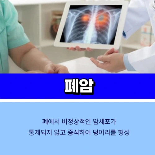 폐암 4기 생존율