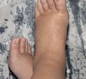 간수치가 높으면 나타나는 증상 32