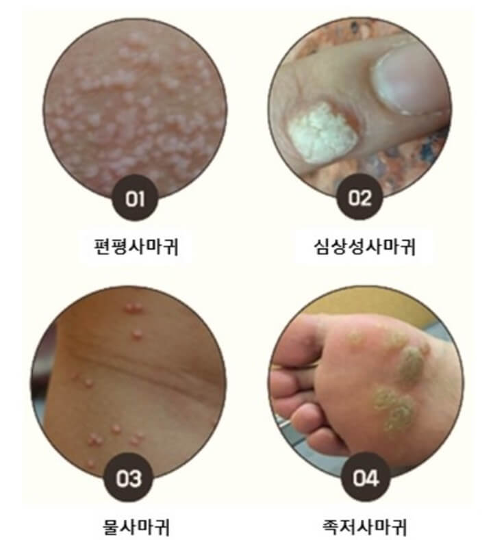 사마귀-종류(편평사마귀-제거-가격-비용)
