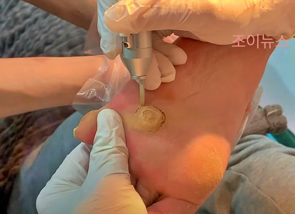 사마귀, 티눈의 병원치료