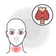 갑상선 기능 항진증의 증상