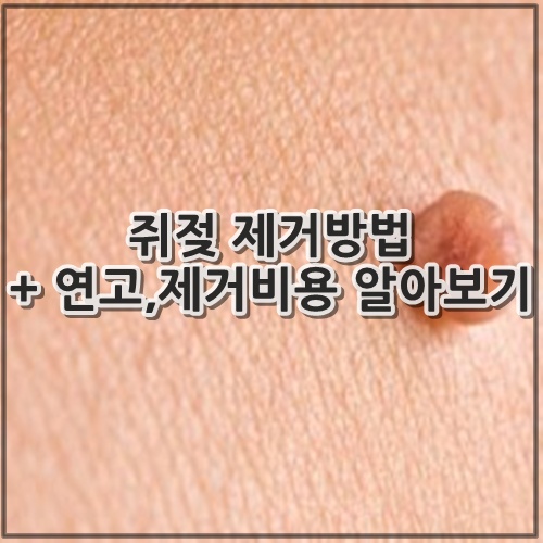 쥐젖 제거방법 + 연고,제거비용 알아보기