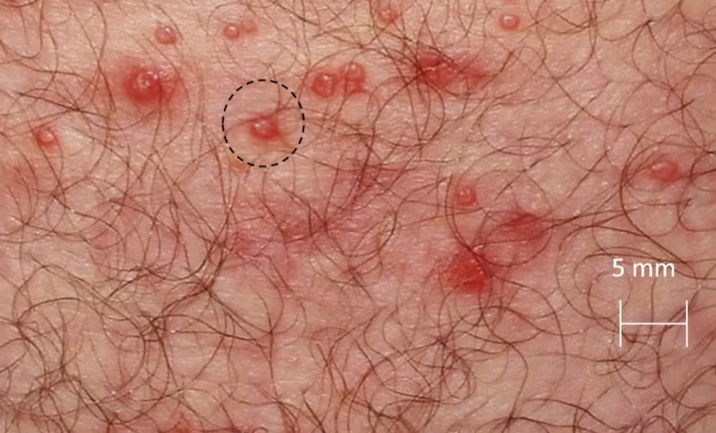 헤르페스 2형 증상