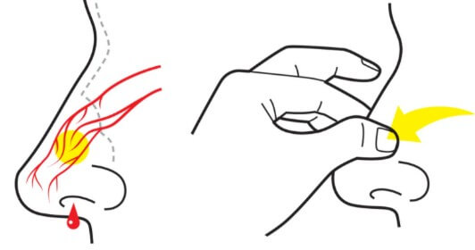 코피가 나는 모습