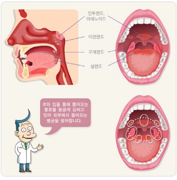 편도결석 제거