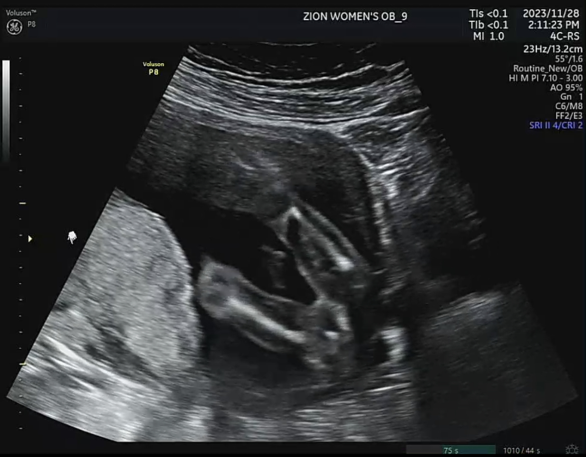 태아 성별 시기