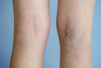 하지 정맥류 증상 치료방법과 예방 생활습관_34