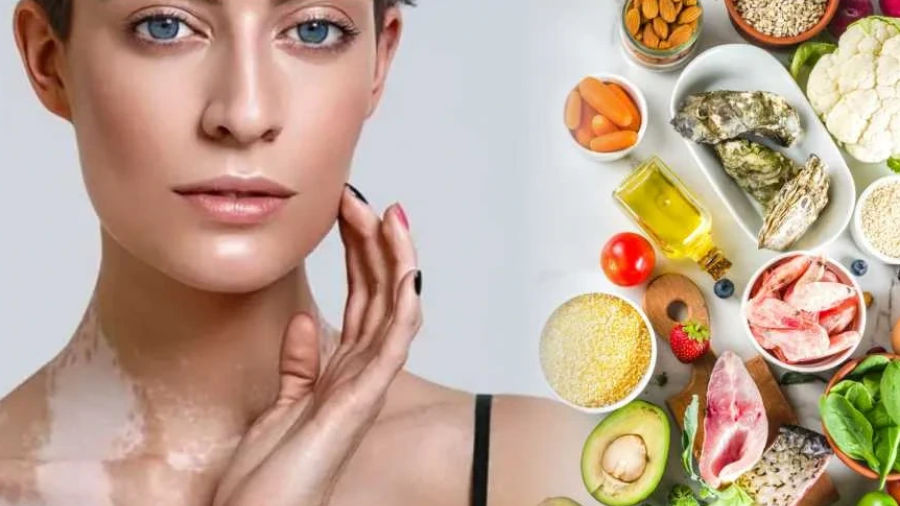 백반증 완벽 가이드