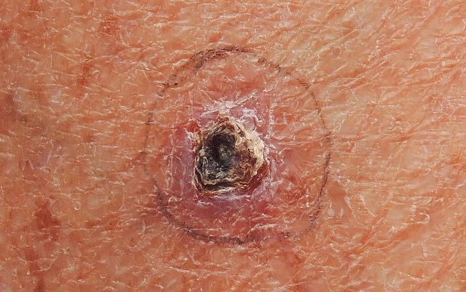 피부암 수술사례