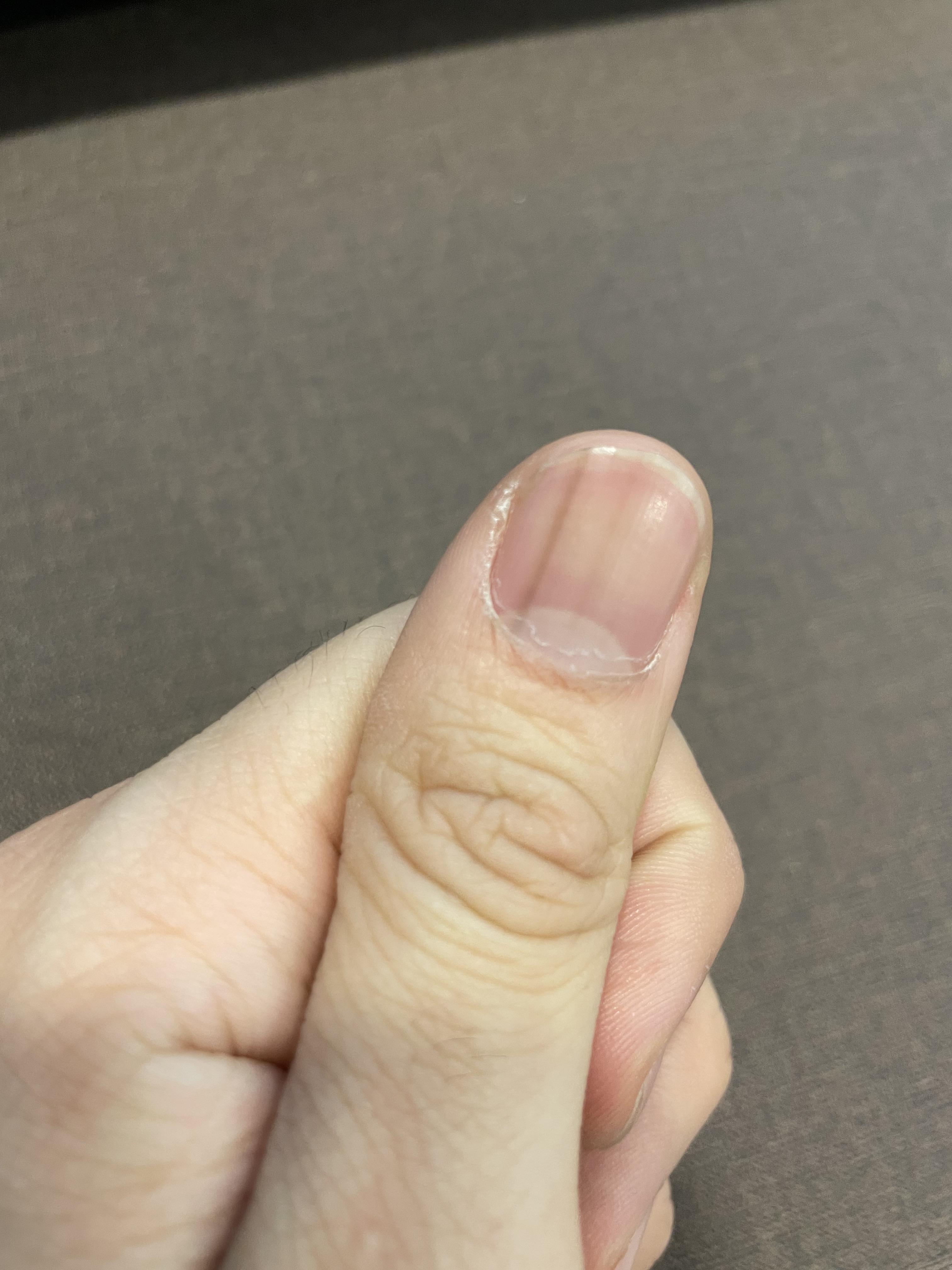 손톱 줄무늬 해결방법