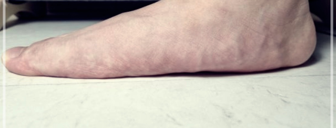 평발슬리퍼에 대한 이해