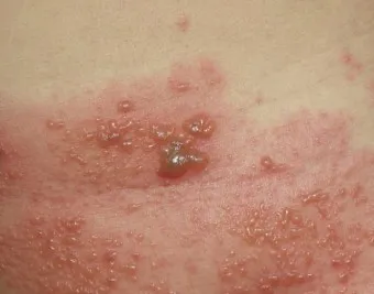 대상포진 감염 증상 부위 손 허리 허벅지_2